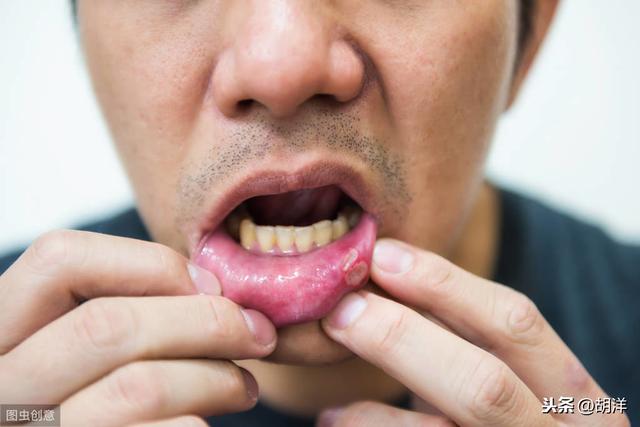 口腔溃疡预示哪些病<strong></p>
<p>币安app最新版</strong>?