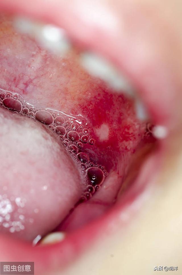 口腔溃疡预示哪些病<strong></p>
<p>币安app最新版</strong>?